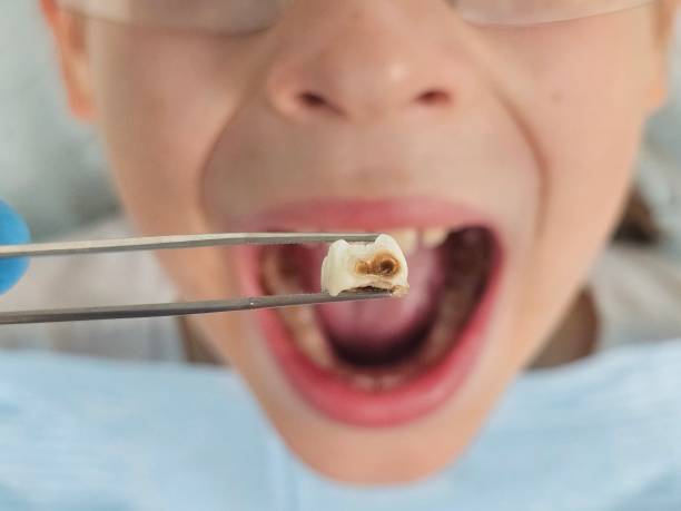 Best Emergency Root Canal Treatment in Hazen, ND